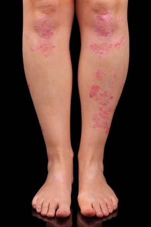 Do You Suffer with Plaque Psoriasis  (Sanford, FL)