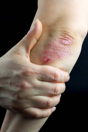 Is PSORIASIS An Issue For You  (Murfreesboro, TN)